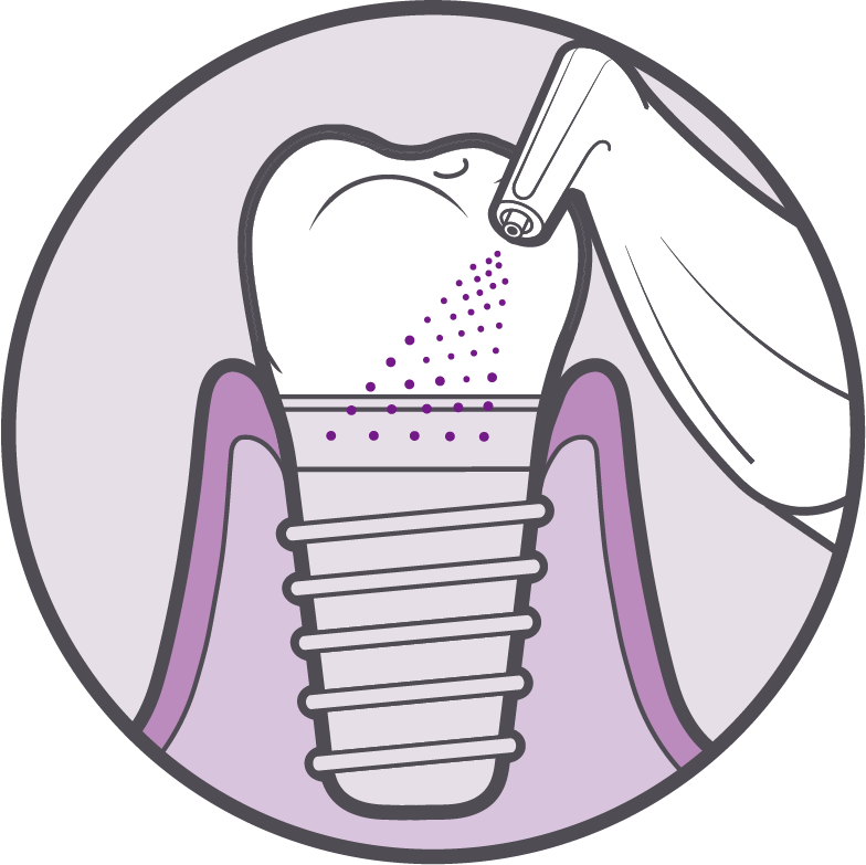 Biofilm Terápia Implantátumos Fogpótlásnál