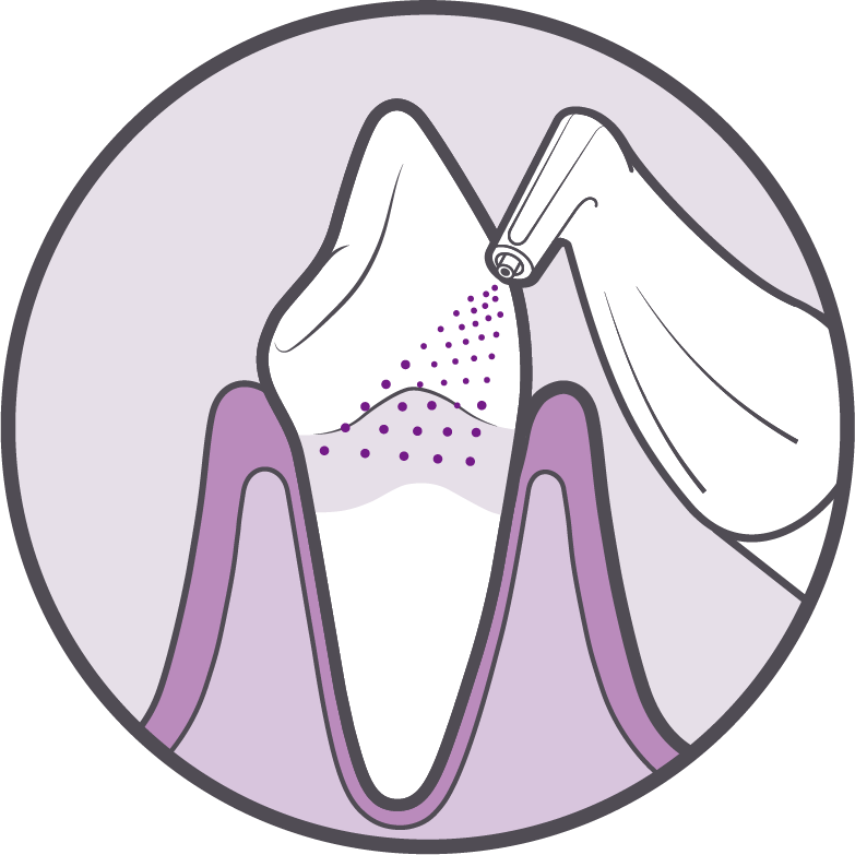 Biofilm Terápia Parodontális Kezelés Előkészítéseként