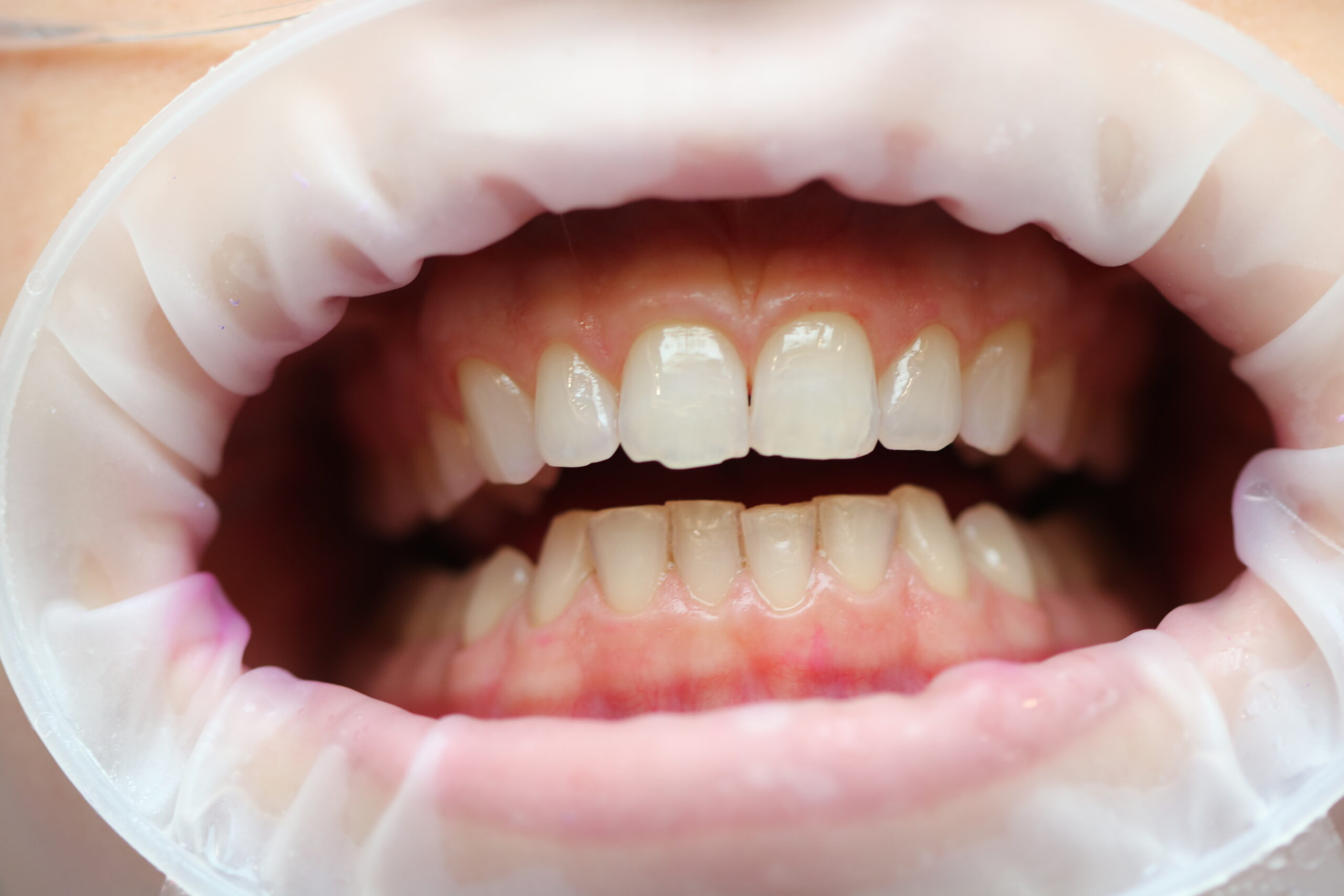 Guided Biofilm Therapy Tökéletes Tisztaság