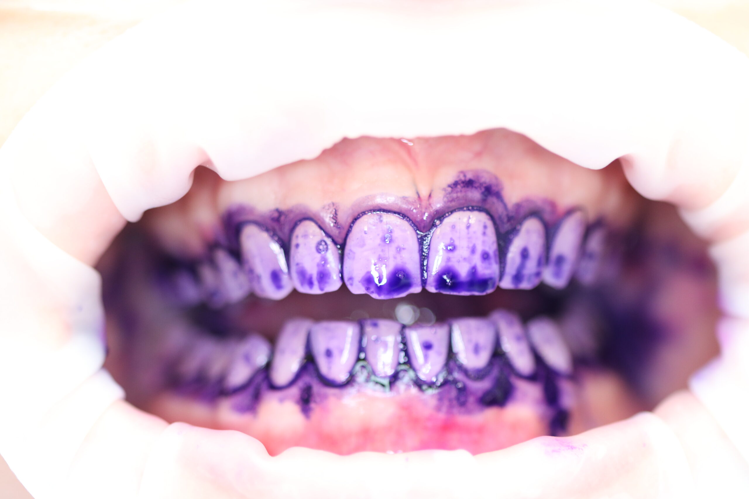 Guided Biofilm Biofilm Láthatóvá Tétele Plakkfestéssel