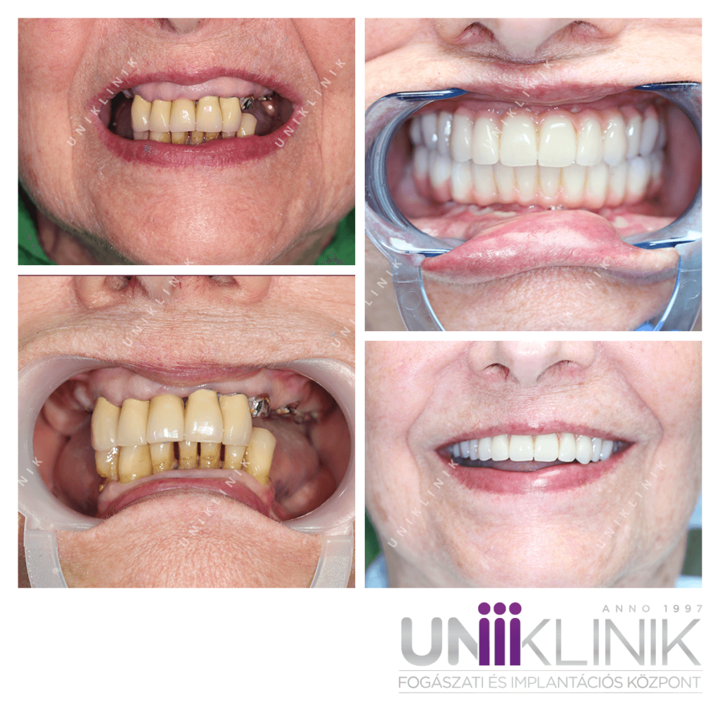 All on 4 fix fogsor teljes értékű megoldás implantátummal