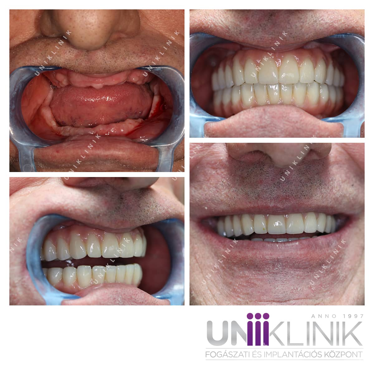 All on 6 teljes rehabilitáció fém kompozit híd