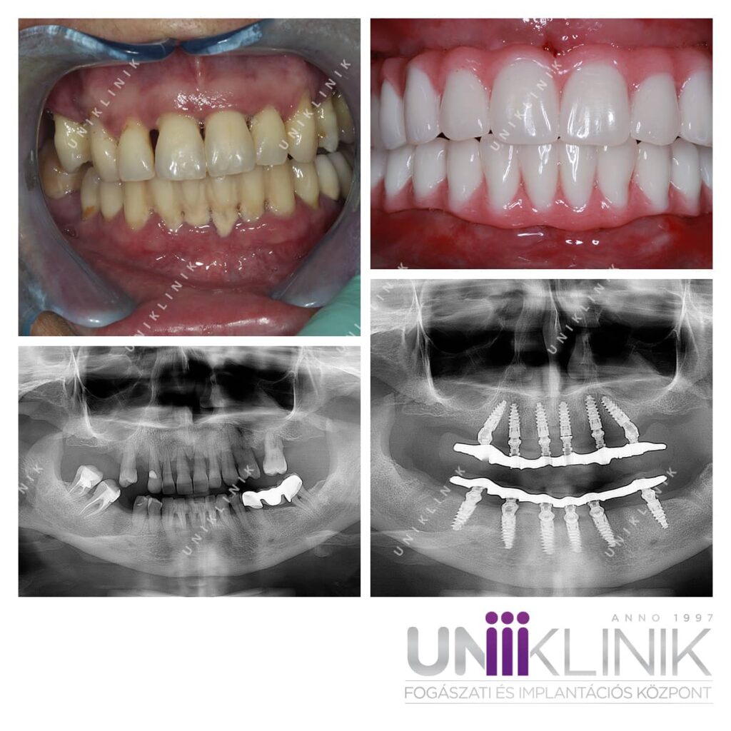 Alpha bio implantátumok beültetése alsó felső állcsontba azonnali terheléséses fix fogpótlással