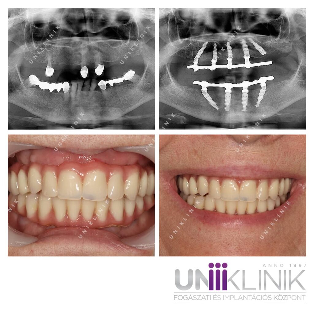 Azonnali fix fogpótlás egy hét alatt– all on 4