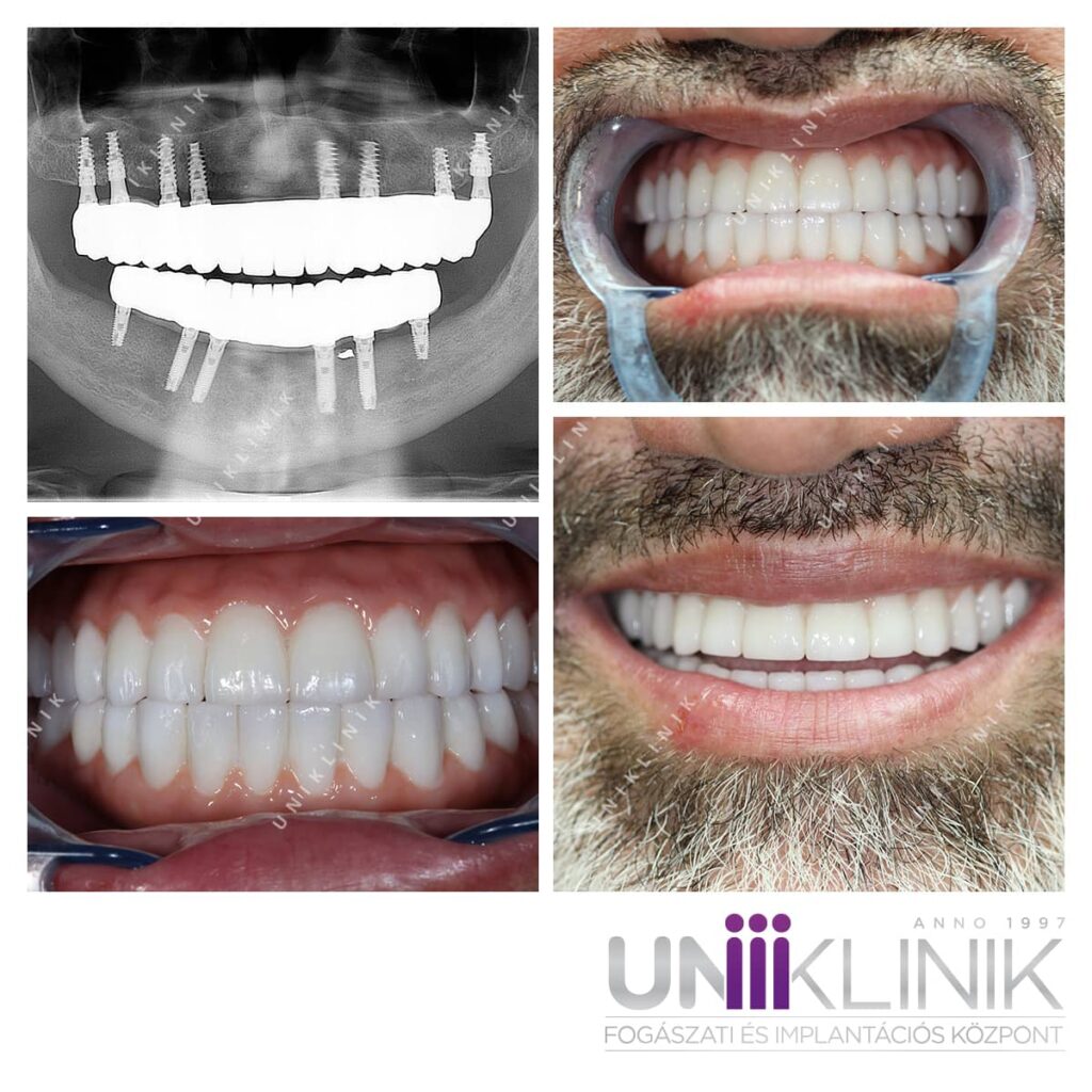 Csavarozható cirkon híd fogászati implantátummal