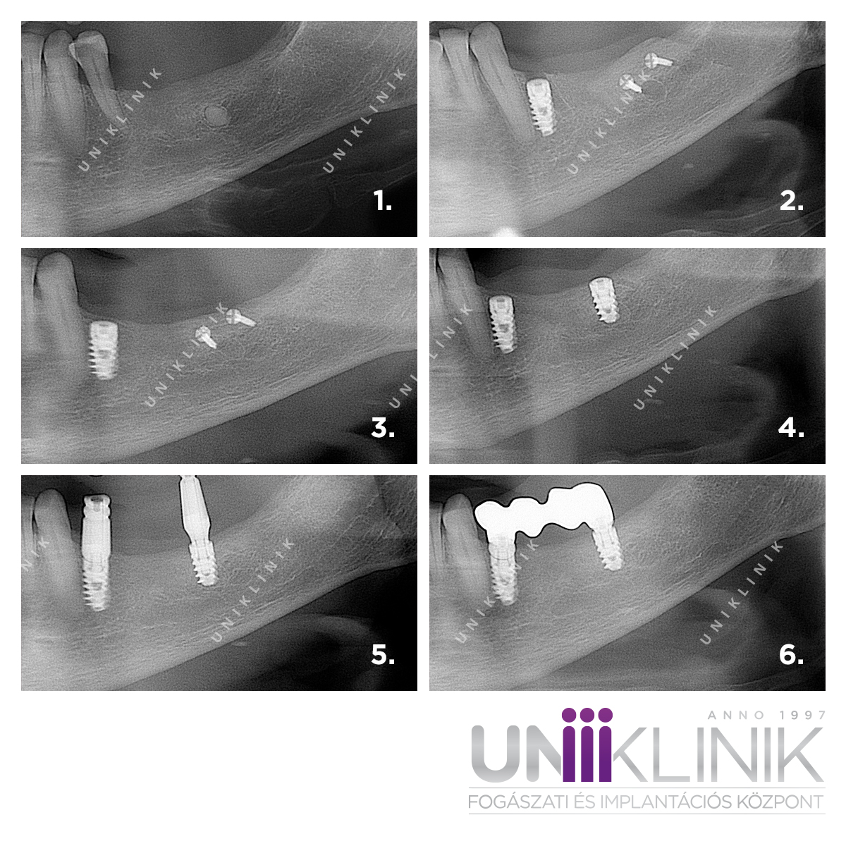 Csontpótlás Implantáció Elótt Csontblokk Műtét