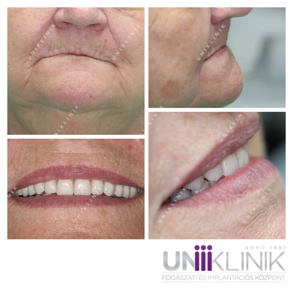 Esztétikus pótlás prémium műfogakkal