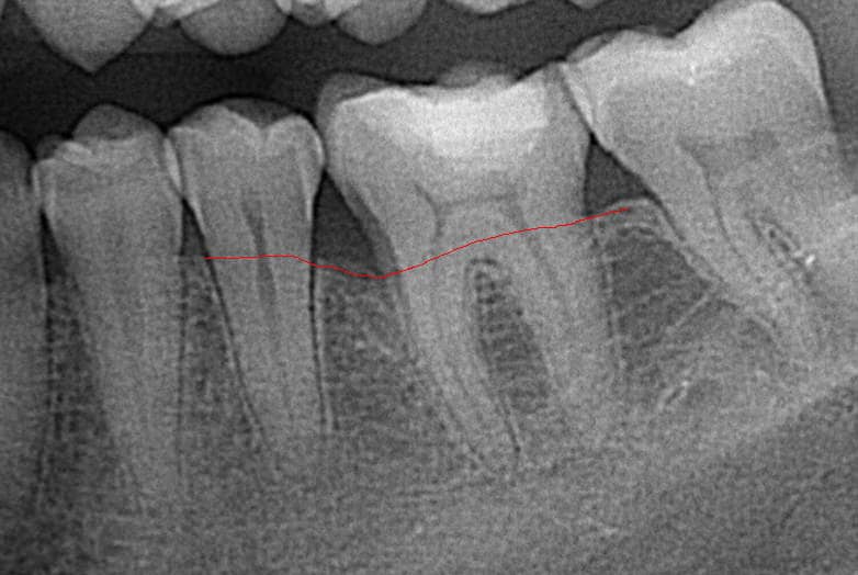 parodontológia tasak