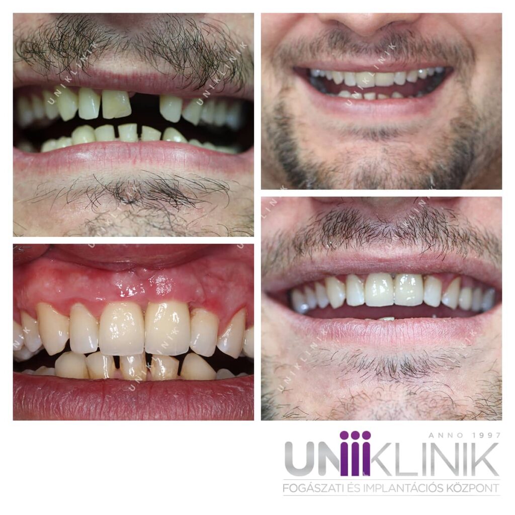  porcelán leplezésű cirkónium korona implantátumon