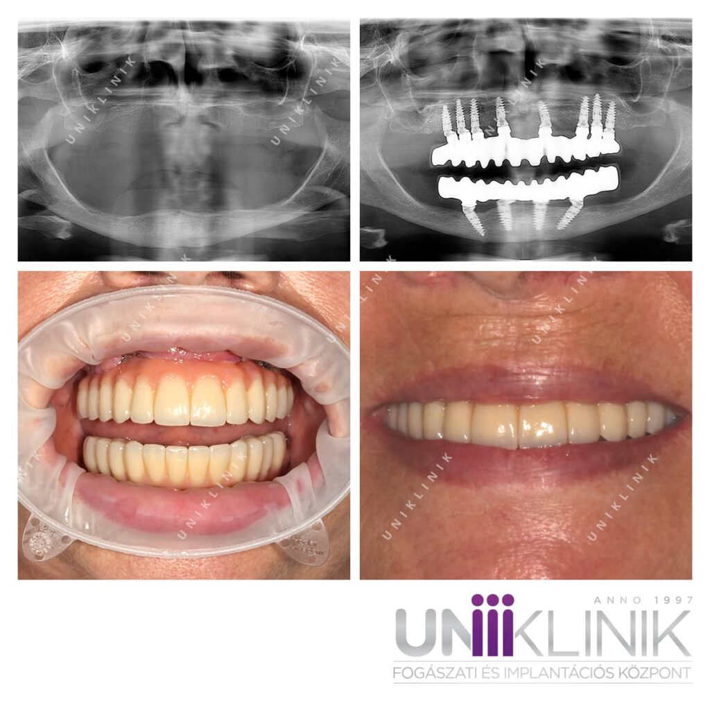  teljes fix fogsor hosszú évek óta fennálló foghiány esetében