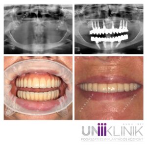 Img teljes fix fogsor hosszú évek óta fennálló foghiány esetében