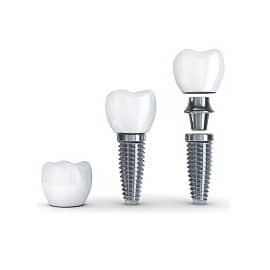 implantáció előnyei