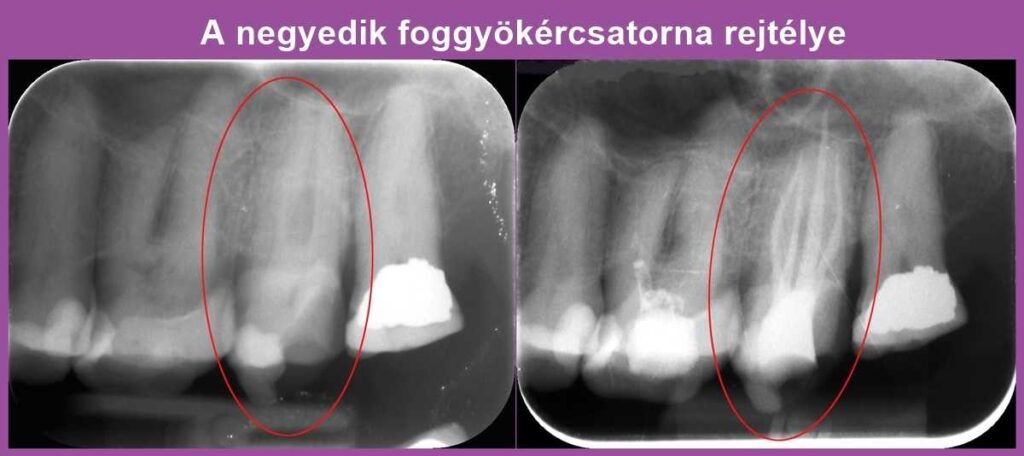 A mikroszkópos gyökérkezelés ezúttal is fogat mentett
