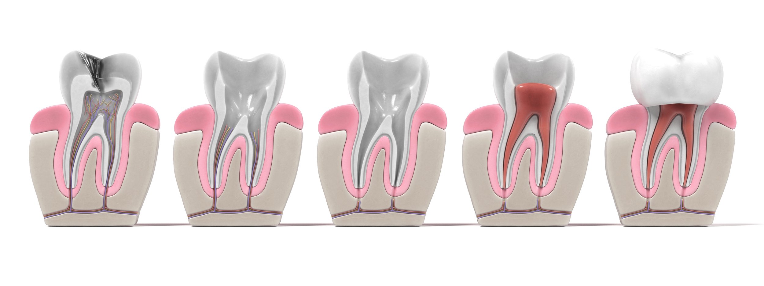 Endodontics Root Canal Procedure