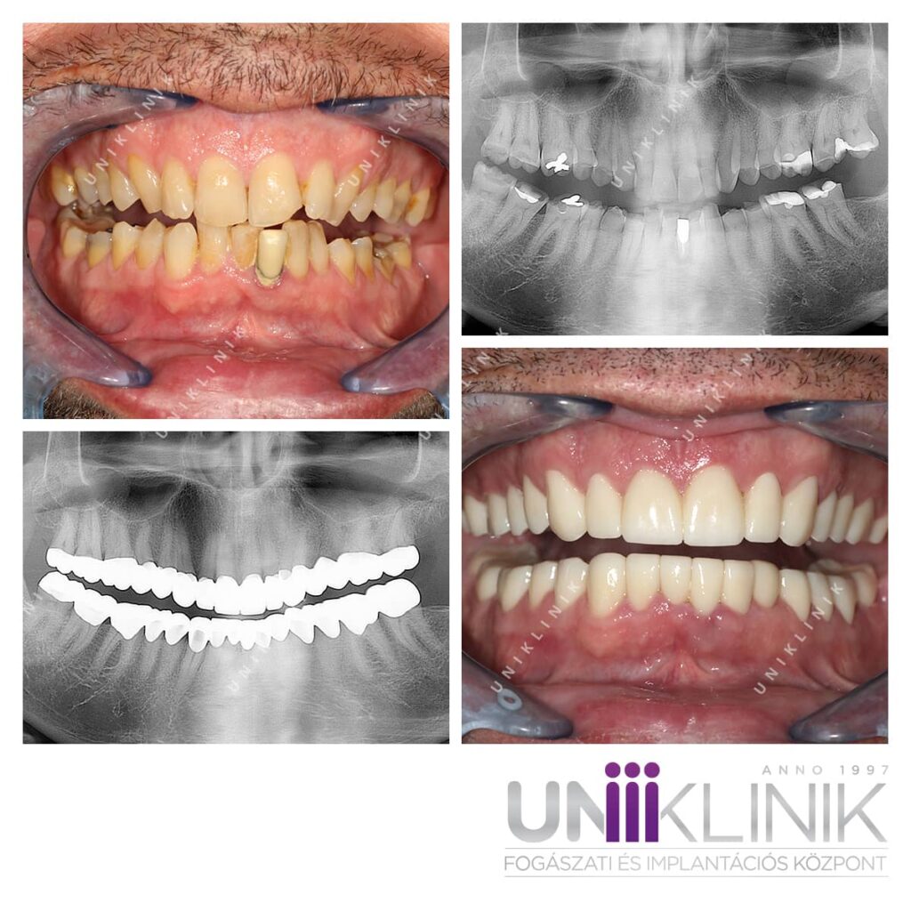 Alsó felső full cirkon koronák és hidak.